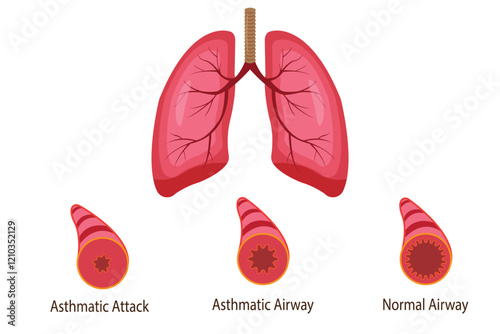 illustration of asthmatic airway,  medical illustration. eps 10