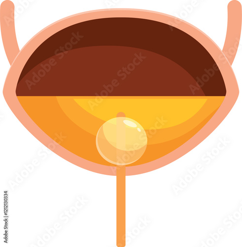 Human urinary bladder storing urine with prostate gland showing benign prostatic hyperplasia