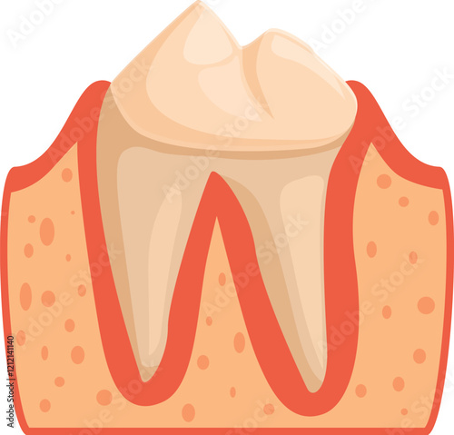 Medical illustration showing periodontitis, a gum infection damaging soft tissues and bones supporting teeth