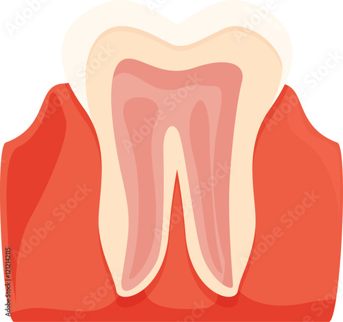 Medical illustration showing periodontitis affecting a human tooth, causing inflammation and receding gums