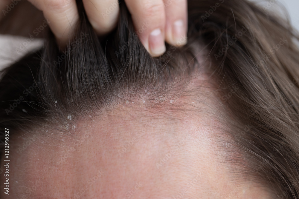 Ταπετσαρία Closeup dandruff flakes on the scalp and on the hair.