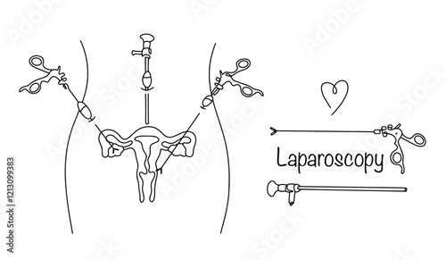 Laparoscopy