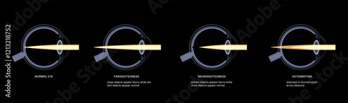 Refractive errors poster