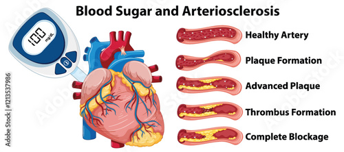 Blood Sugar and Arteriosclerosis Illustration