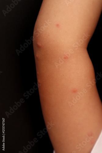 Elbow arm of a toddler girl suffering from chicken pox or varicella caused by the Varicella zoster virus, close-up view.
 photo