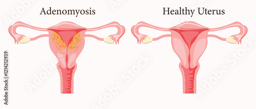 Diffuse Adenomyosis Human anatomy Female reproductive Sick system vs versus normal. Compared educational healthy and abnormal anatomy organs uterus. eps 10. medical illustration