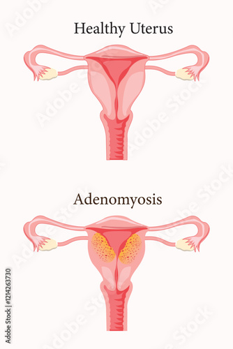 Diffuse Adenomyosis Human anatomy Female reproductive Sick system vs versus normal. Compared educational healthy and abnormal anatomy organs uterus. vector eps 10. medical illustration