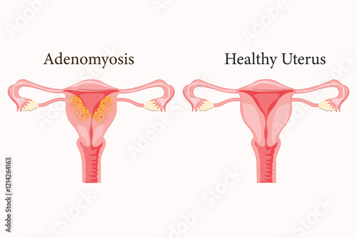 Diffuse Adenomyosis Human anatomy Female reproductive Sick system vs versus normal. Compared educational healthy and abnormal anatomy organs uterus. eps 10. medical illustration