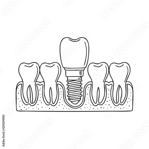 A close-up of a dental implant seamlessly integrated among natural teeth in the gumline
