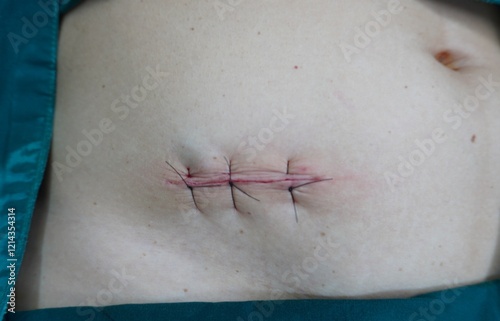 Vertical mattress suture technique, surgical stitch at the end of operation for appendicitis