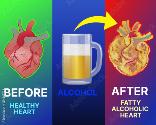 Heart disease. Fatty heart. Alcoholic cardiomyopathy. Long-term consumption of alcohol leads to heart failure. Educational illustration. Healthcare illustration. Vector illustration. 