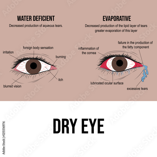 Dry eye, eye disease due to insufficient lubrication.