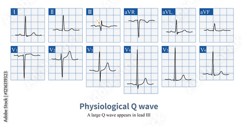 Male, 23 years old, healthy. When the initial excitation potential of the ventricle deviates from a certain lead axis, a Q wave will be projected onto that lead, which is a physiological Q wave. photo