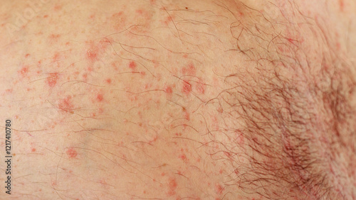 Close up to caucasian skin with red rashes called hives or urticaria