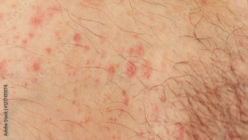 Close up of hives or urticaria on caucasian skin