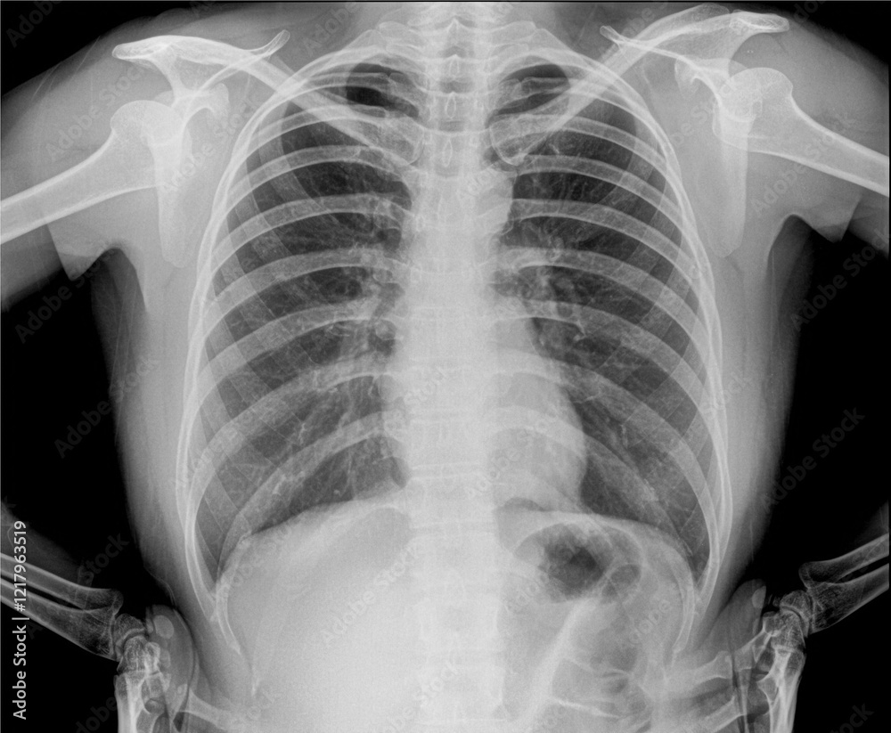 photo x ray of infected lungs photo x ray of infected lungs