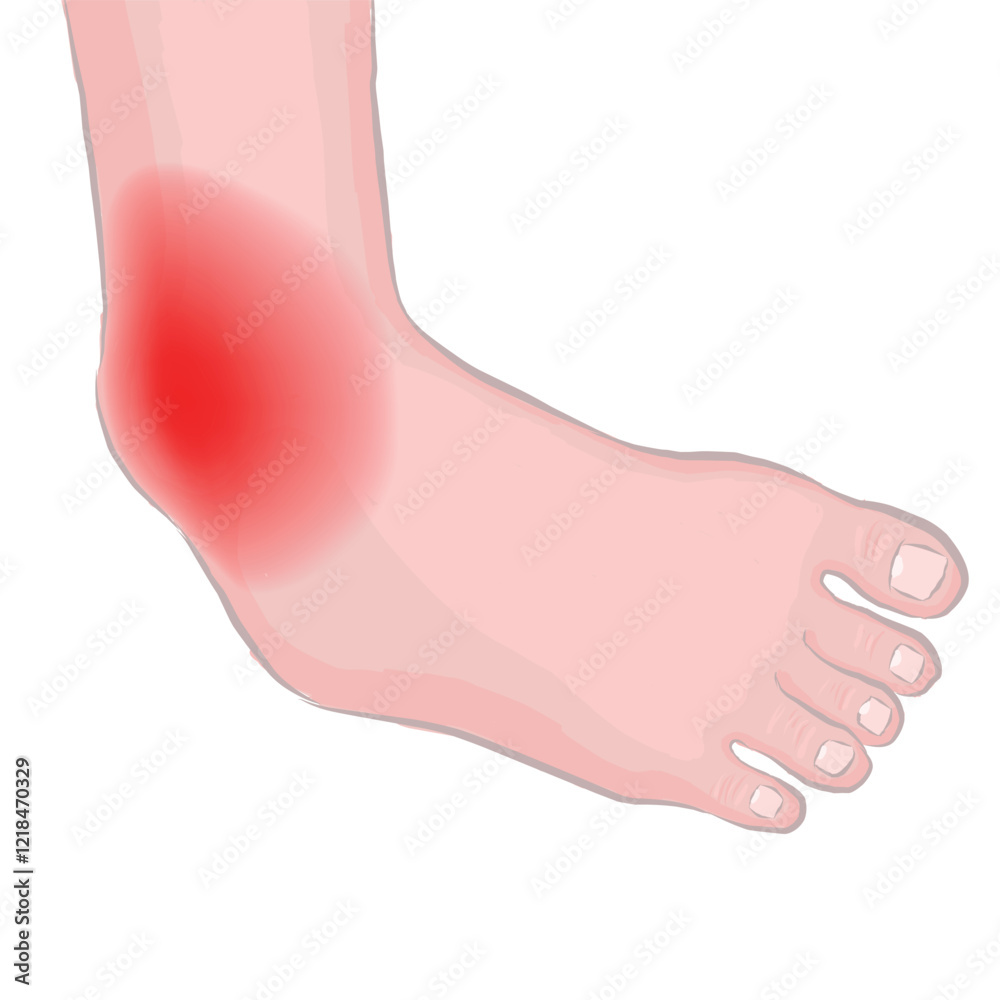 ankle fracture. Vector medical illustration. Image of a foot with a dislocation