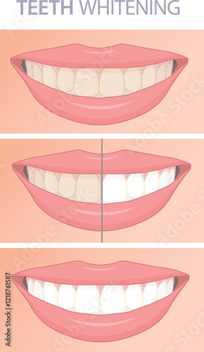 Teeth whitening realistic vector illustration. Stomatology and dentistry infographic concept showing human smile, 
 teeth before and after.