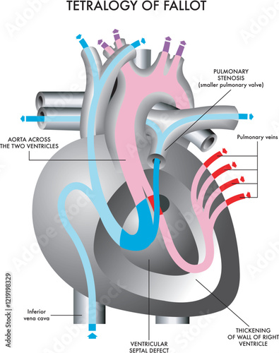 Schematic illustration of the symptoms of Tetralogy of Fallot, a congenital heart defect, with annotations.
