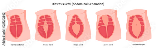 Type of abdominal muscle separation after surgical which in medical called Diastasis Recti belly