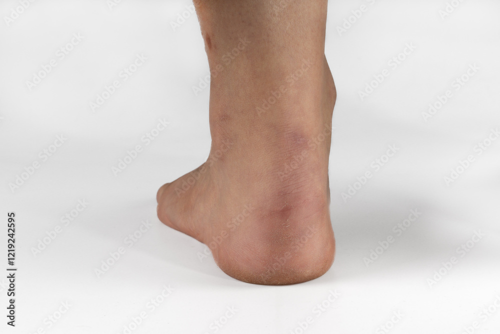 Cracked heel with close up of the crack. Dry flaky skin heel, callous heel. Cracked heel with close up of the crack. Dry flaky skin heel, callous heel.