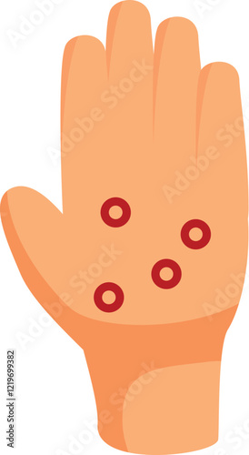 Skin infection with red blisters on palm, monkeypox virus symptom, dermatology study