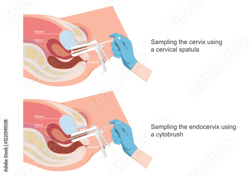 Sampling the endocervix using the endocervical brush and using the cytobrush.