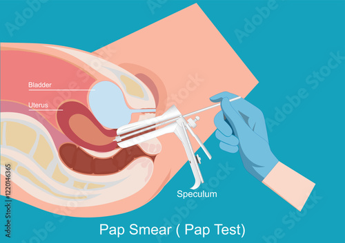 Sampling the endocervix using the cervical brush