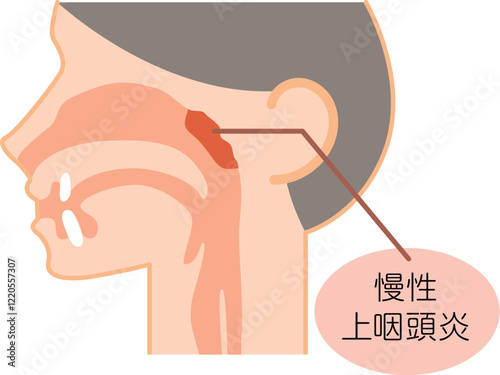 慢性上咽頭炎の説明図・カラー・シンプルな図解_イラスト