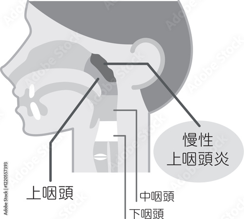 慢性上咽頭炎の説明図・白黒・図解_イラスト