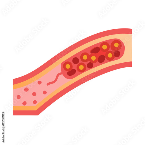 Cholesterol Blocked Artery and Accumulation of Cholesterol