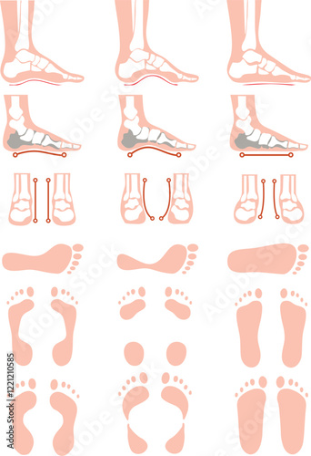 anatomia stopy, deformacje stopy