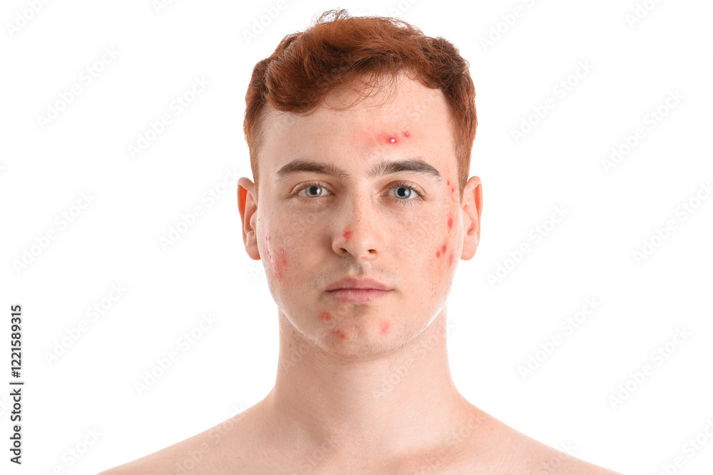 Obraz premium Teenage boy with acne on white background