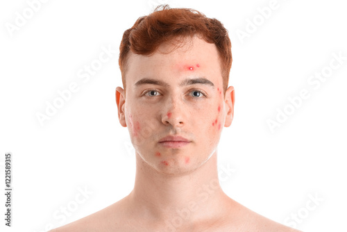Teenage boy with acne on wh...