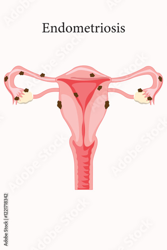 endometriosis, female problem. medical illustration. eps 10