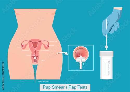 Cervical Cancer Screening or Pap Test