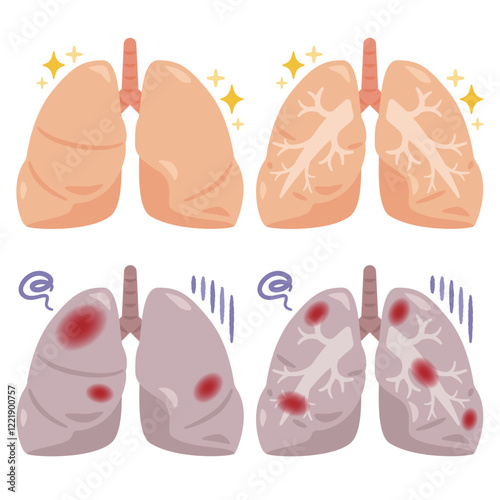 健康でキレイな肺と炎症が起きた不健康な肺のイラスト