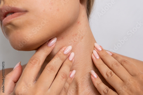 Red rash under jaw. Young caucasian woman touching her neck with hands showing acne problem. Allergies, pimples, hormonal changes. Problem skin, sweating sickness, prickly heat. Dermatology. Close-up
