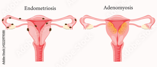 Anatomical illustration of the  female reproductive system with the symptoms of adenomyosis and the symptoms of endometrioses, with annotations. medical illustration. eps 10