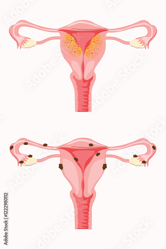 Anatomical illustration of  symptoms of adenomyosis and the symptoms of endometrioses, with annotations. eps 10