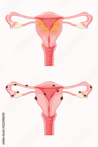 Anatomical illustration of the  female reproductive system with the symptoms of adenomyosis and the symptoms of endometrioses, with annotations. eps 10