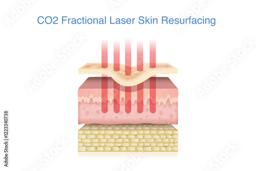 Skin layer with  acne scar treated by CO2 fractional laser into middle layer. 3D illustration about technology for healing scars and reduce wrinkles.