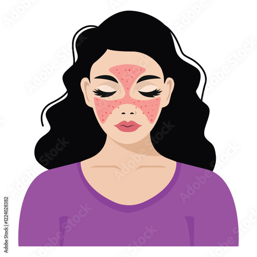 Red Systemic Lupus Erythematosus Young woman with the typical butterfly rash in lupus Illustration