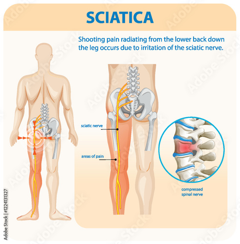Understanding Sciatica and Its Symptoms
