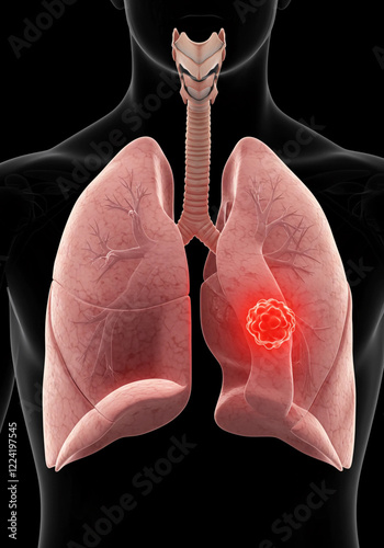 Visualization of Lungs and Trachea with Highlighted Tumor: A graphic showing the lungs and trachea, emphasizing a tumor. photo