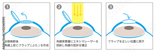 レーシック手術の3ステップ図解-日本語-