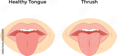 Healthy Tongue vs Thrush Design Vector Illustration