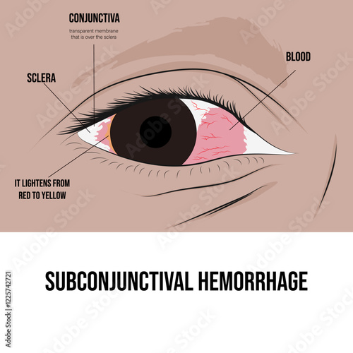 Subconjunctival hemorrhage, bleeding that occurs when a blood vessel in the eye breaks.