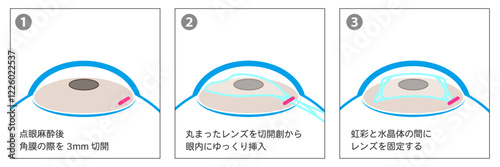 ICL手術の工程図解-日本語-