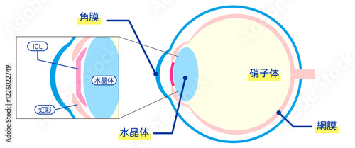 ICL手術の解剖学的図解-日本語-